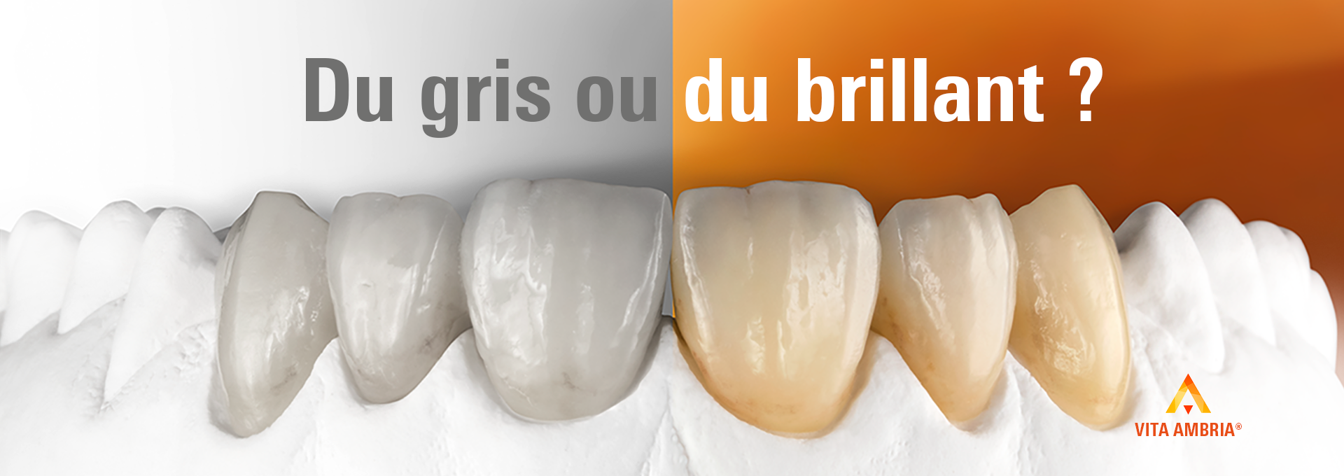 Lingotin en c&eacute;ramique press&eacute;e VITA AMBRIA et couronnes ant&eacute;rieures sur mod&egrave;le