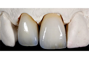 Die beiden fertigen Kronen wirkten schon auf dem Modell absolut nat&uuml;rlich.
