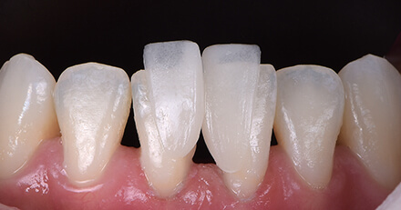 VITA VMK Master&reg;