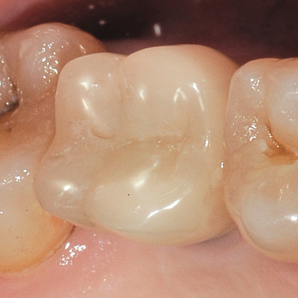 After insertion, the screw channel was closed with composite.