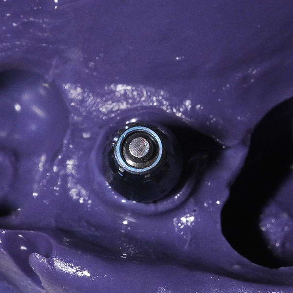 L&rsquo;impronta &egrave; stata eseguita con un portaimpronte perforato.