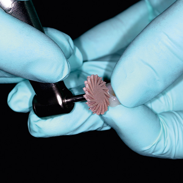 Die fertige hybridkeramische Krone wurde abschlie&szlig;end hochglanzpoliert.