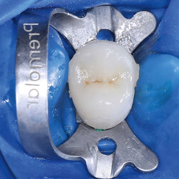 Zustand direkt nach der volladh&auml;siven Eingliederung, vor der Entfernung der Zementreste.