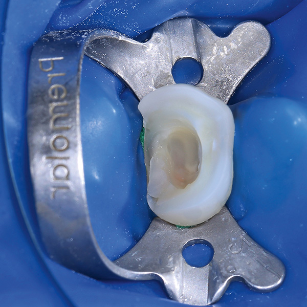 Le collage a d&eacute;but&eacute; sous digue dentaire par un mordan&ccedil;age de la cavit&eacute;.