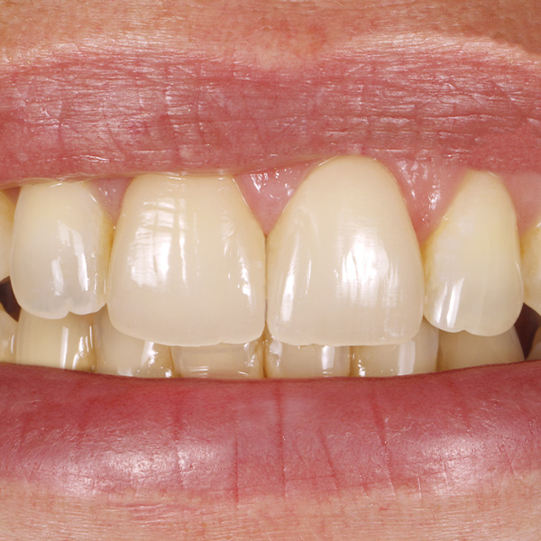 Resultado: El contorno de los bordes incisales armoniz&oacute; con el contorno de los labios.