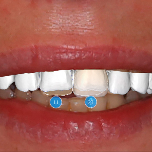 Mediante la aplicaci&oacute;n CEREC-Smile Design se pueden evaluar las restauraciones junto con los labios.