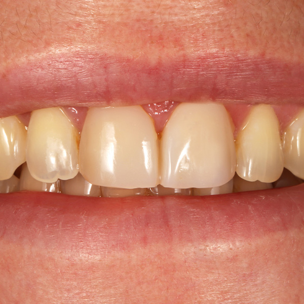 Le mod&egrave;le correspondait aux attentes esth&eacute;tiques de la patiente.