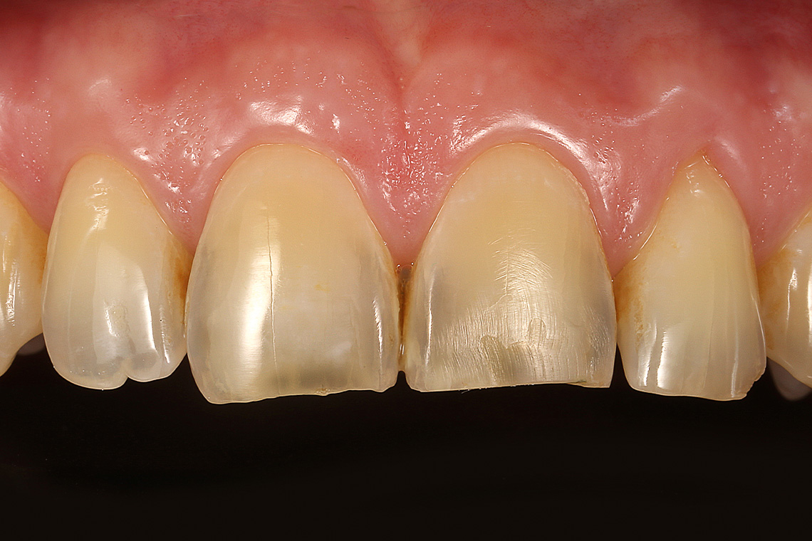 Erosione ed abrasione hanno causato accorciamento del bordo incisale e perdita della morfologia dei denti.