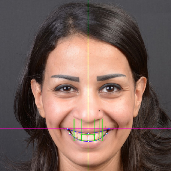 Das Digital Smile Design wurde in die Software NemoDSD 3D &uuml;bertragen &hellip;
