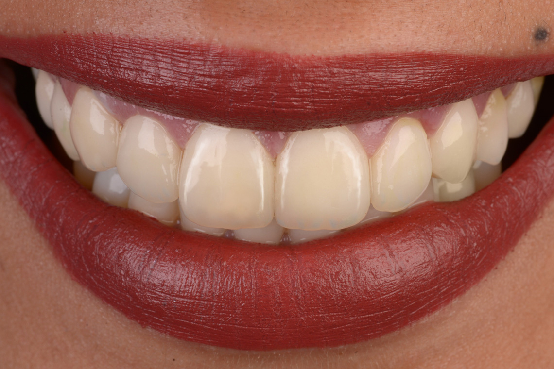 Una preparaci&oacute;n de mock-up guiada posibilit&oacute; una remoci&oacute;n de esmalte controlada y m&iacute;nimamente invasiva.