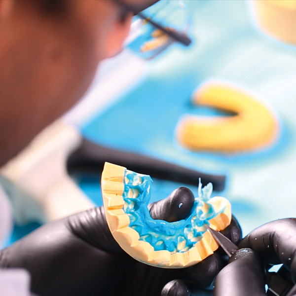 La llave de silicona confeccionada se molde&oacute; mediante un bistur&iacute; a lo largo del margen gingival.