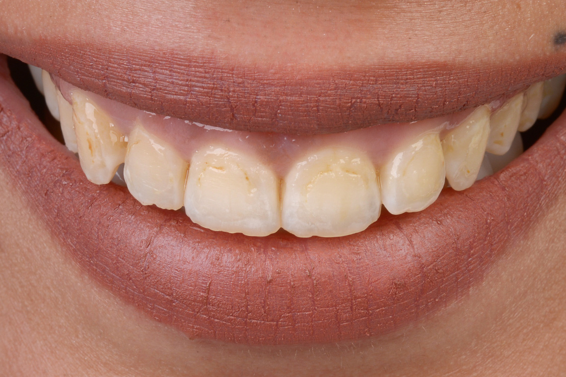 La situation initiale avec un sourire gingival et des incisives courtes dans la zone esth&eacute;tique.