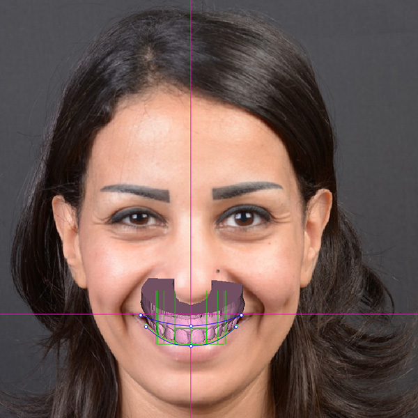 &hellip;, pour r&eacute;aliser un mod&egrave;le virtuel de wax-up.