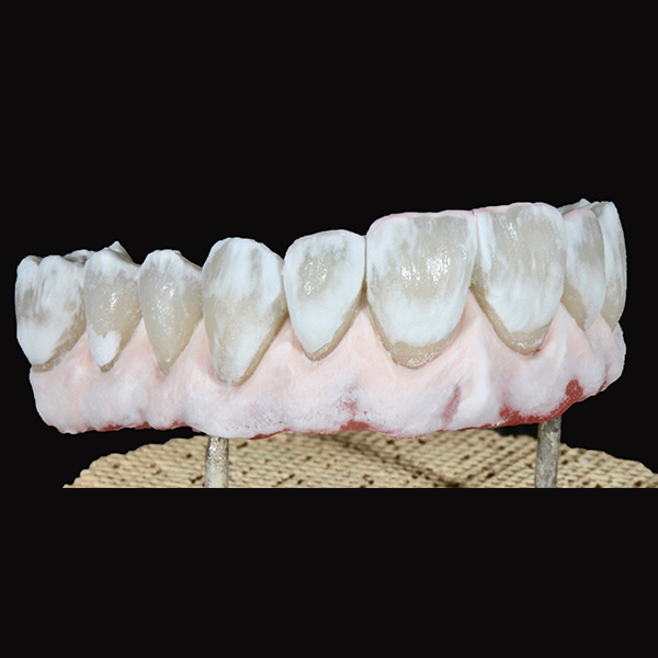 Der Korrekturbrand wurde dental mit PEARL shell und gingival mit GINGIVA light-rose durchgef&uuml;hrt.