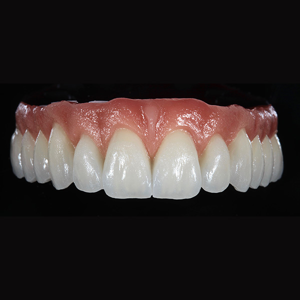 Die Versorgung nach der Ausarbeitung mit Diamanten und Gummipolierern.