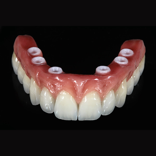 Die fertige, glasierte implantatprothetische Arbeit wirkte absolut nat&uuml;rlich.