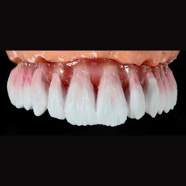 Die erste Schmelzschichtung wurde in den oberen zwei Dritteln mit ENAMEL clear durchgef&uuml;hrt.