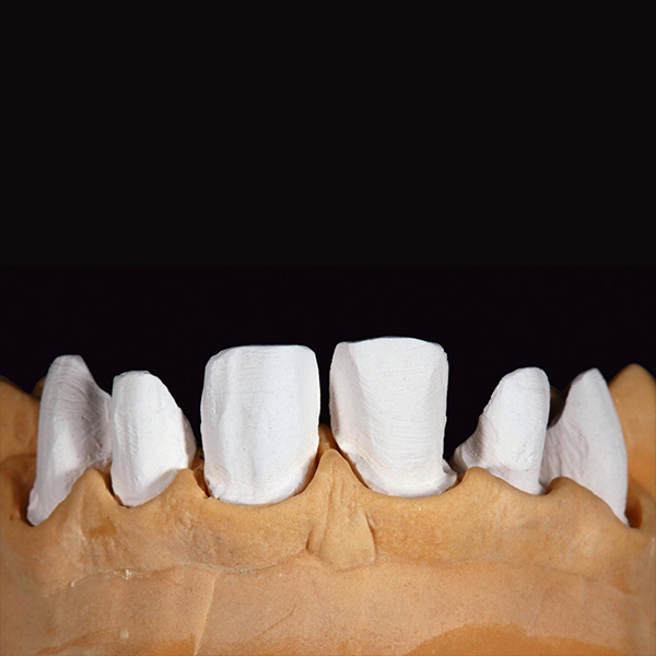 Das fertige Meistermodell stand f&uuml;r die Herstellung der Veneers bereit.