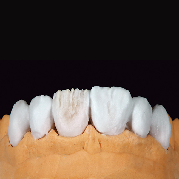 Die abschlie&szlig;ende Formgebung der sechs Veneers erfolgte mit ENAMEL light.