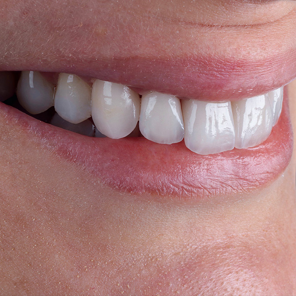 Der Zahnbogen war nach den Regeln der &Auml;sthetik ausgeformt.