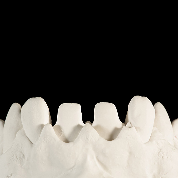 Die f&uuml;r eine Vollkrone pr&auml;parierten Modellst&uuml;mpfe an 11 und 21.