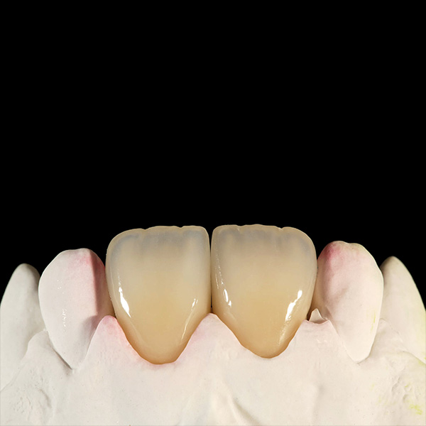 Das hoch&auml;sthetische Ergebnis nach Ausarbeitung und rein mechanischem Finishing.