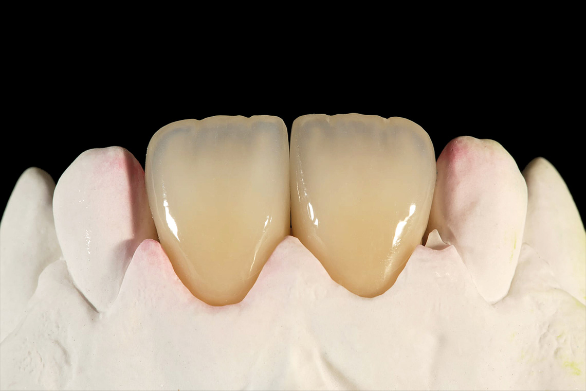 Das hoch&auml;sthetische Ergebnis nach Ausarbeitung und rein mechanischem Finishing.