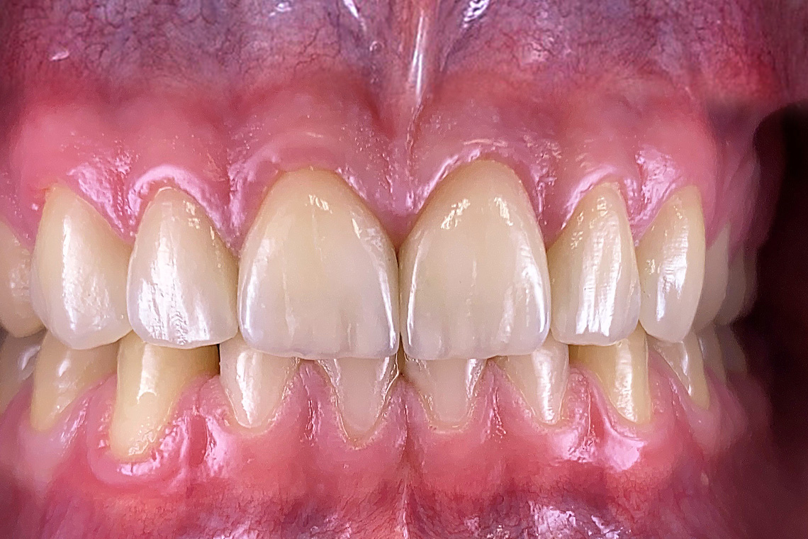 Das abschlie&szlig;ende Ergebnis nach der volladh&auml;siven Zementierung der hoch&auml;sthetischen Veneers.
