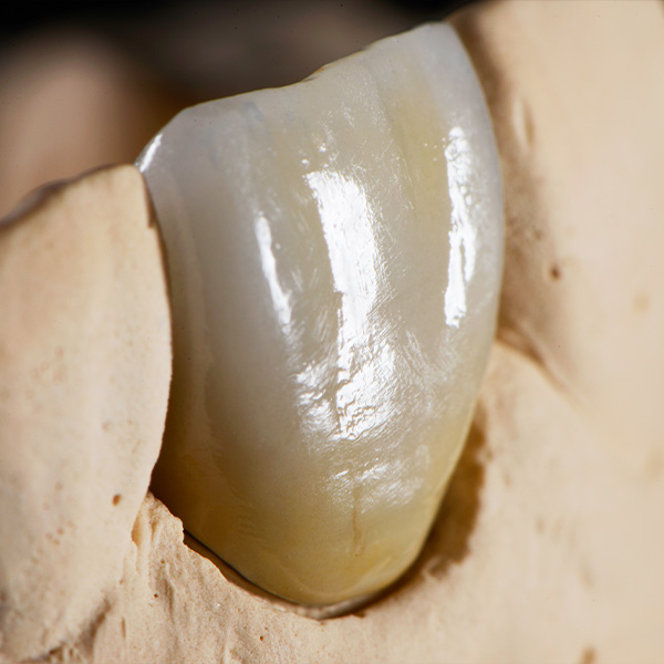 Die titankeramische Krone mit VTA LUMEX AC wirkte absolut lebendig und nat&uuml;rlich.