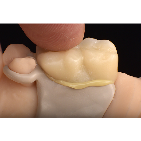 Am entstandenen &Uuml;berschuss wird der homogene Klebespalt deutlich.