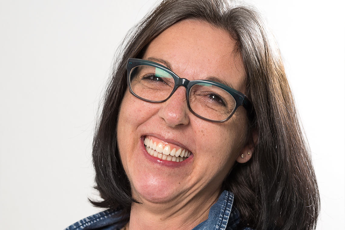 R&eacute;sultat : la patiente &eacute;tait impressionn&eacute;e par le r&eacute;sultat tr&egrave;s esth&eacute;tique et la fonctionnalit&eacute; de la nouvelle proth&egrave;se.