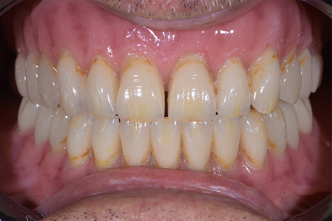 Le travail proth&eacute;tique total fini et poli.