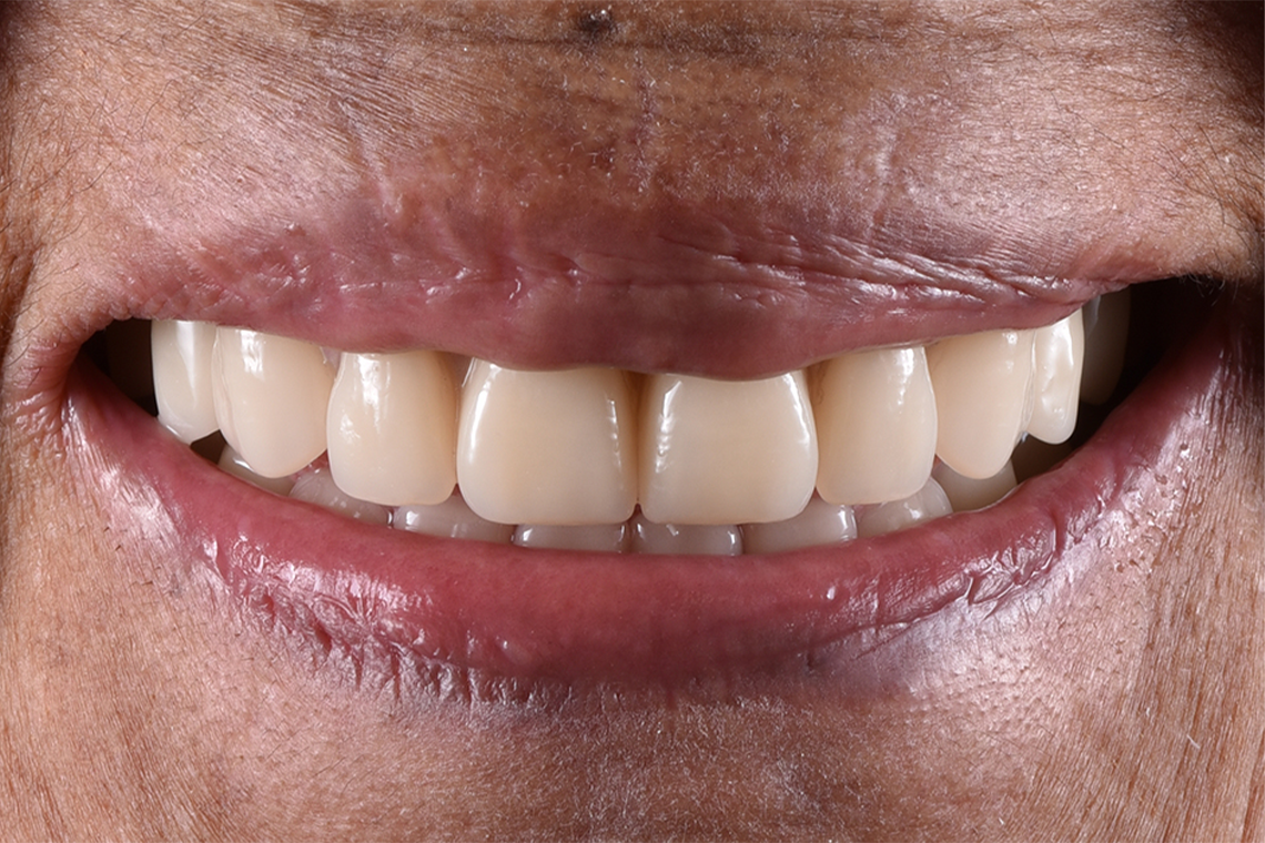 R&Eacute;SULTAT : La patiente &eacute;tait absolument satisfaite de la fonction et de l'esth&eacute;tique de sa nouvelle restauration