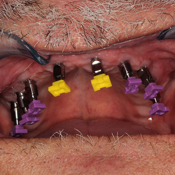 Des analogues ont &eacute;t&eacute; viss&eacute;s sur les implants ost&eacute;oint&eacute;gr&eacute;s.