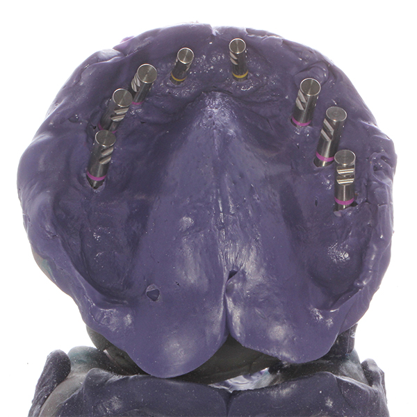 Les empreintes de fixation ont &eacute;t&eacute; prises au maxillaire et &agrave; la mandibule avec le porte-empreinte.