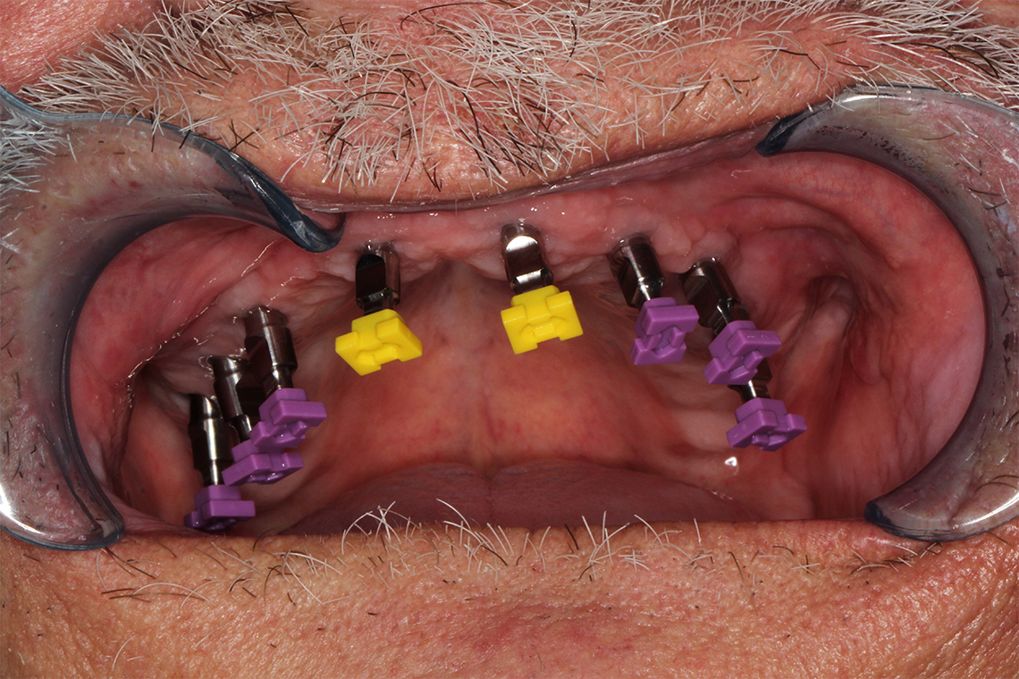 Des analogues ont &eacute;t&eacute; viss&eacute;s sur les implants ost&eacute;oint&eacute;gr&eacute;s.