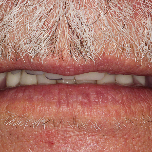 En position de repos, un trac&eacute; non harmonieux des bords incisifs a &eacute;t&eacute; mis en &eacute;vidence.