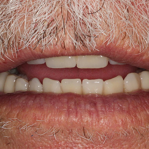 En cas de l&eacute;g&egrave;re ouverture, les bords incisifs pr&eacute;sentaient finalement un trac&eacute; harmonieux.