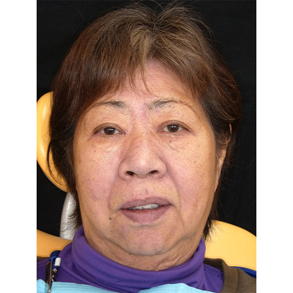 la patiente &eacute;tait satisfaite de la nouvelle r&eacute;alsiation.