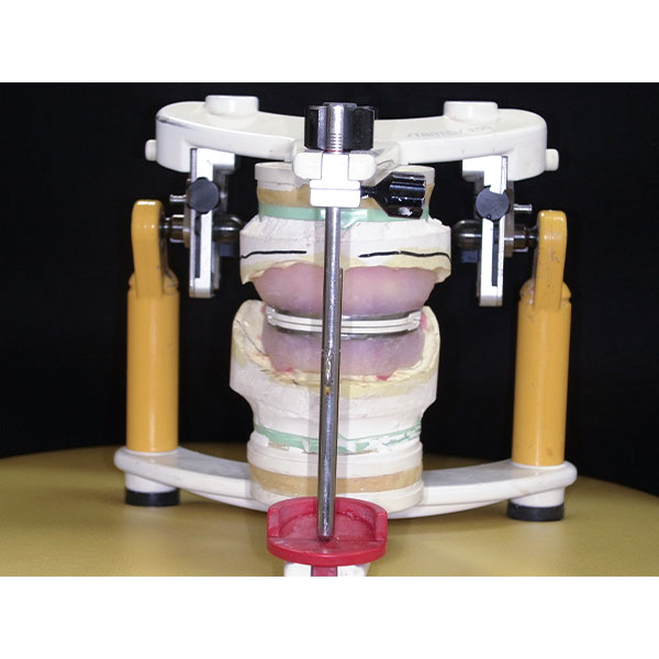 Des maquettes d'occlusion ont &eacute;t&eacute; fabriqu&eacute;s sur des ma&icirc;tres-mod&egrave;les pour un enregistrement de la centr&eacute;e.