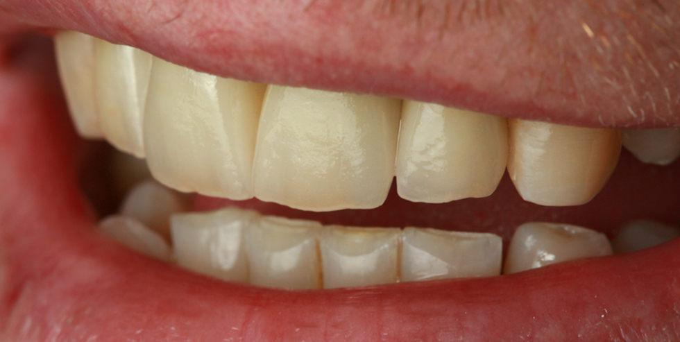 VITA Patientenfall: Urszula Młynarska. Die mit VMK Master&reg; verblendeten Restaurationen.