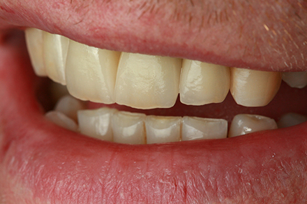 Step 12 Nat&uuml;rlicher Oberfl&auml;chenglanz VITA VMK Master&reg;