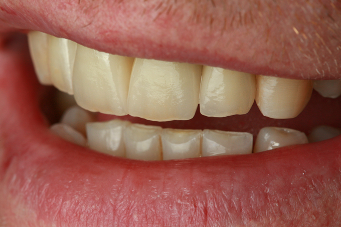 Step 12 Nat&uuml;rlicher Oberfl&auml;chenglanz VITA VMK Master&reg;