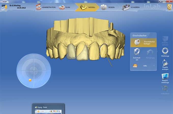 Step 3 constructed non-prep-veneers Step 3 constructed non-prep-veneers