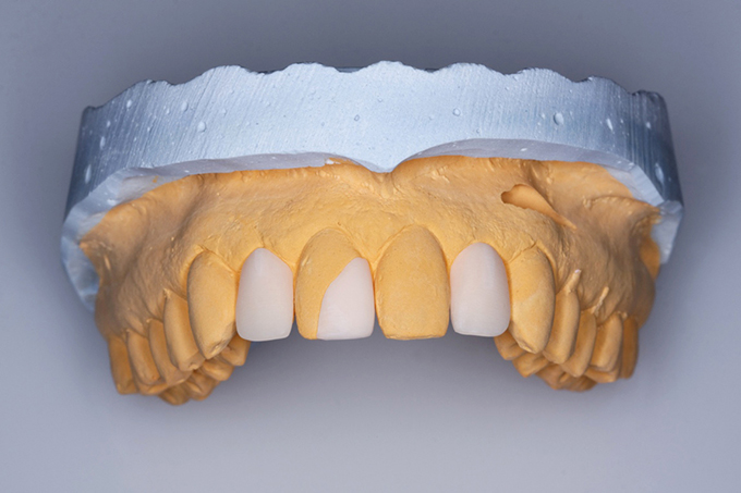 Fitting directly after milling using Sirona inLab MC XL. Fitting directly after milling using Sirona inLab MC XL.