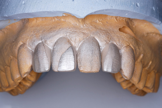 Step 5 Adaptation of the veneers Step 5 Adaptation of the veneers