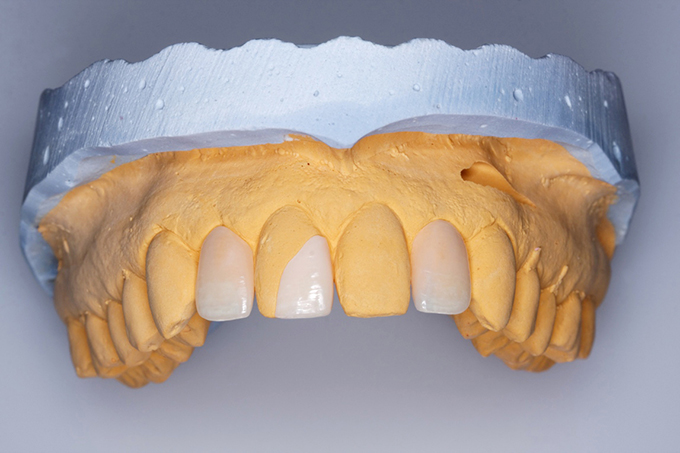 Step 8 Final prepared restoration prior to placement. Step 8 Final prepared restoration prior to placement.