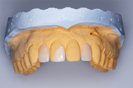 Step 8 Final prepared restoration prior to placement. Step 8 Final prepared restoration prior to placement.