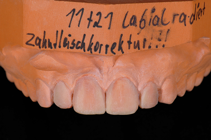 Step 3 Zahnfleischkorrektur Step 3 Zahnfleischkorrektur