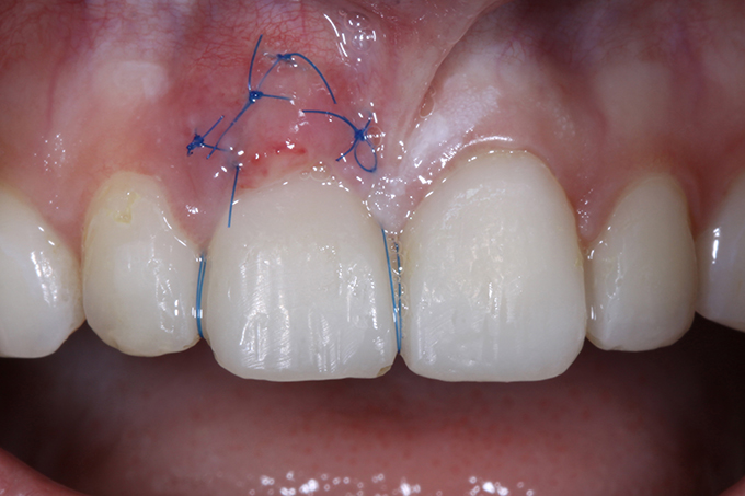 Step 4 Provisorium Step 4 Provisorium